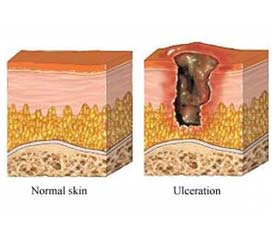 Ulceras en la piel